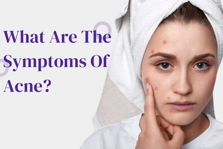 What are the symptoms of acne?