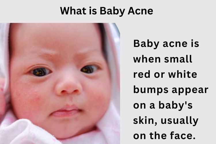 Baby Acne