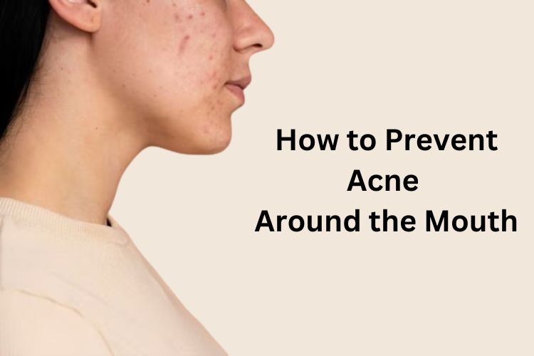 Acne Around the Mouth