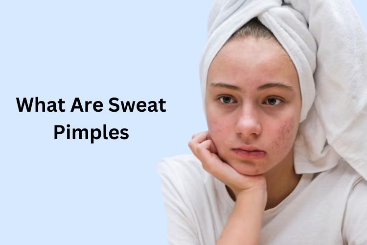 Sweat Pimples