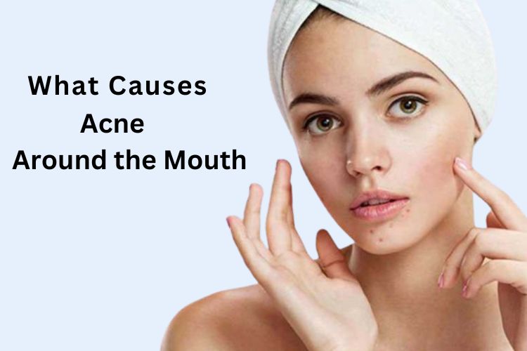 Acne Around the Mouth